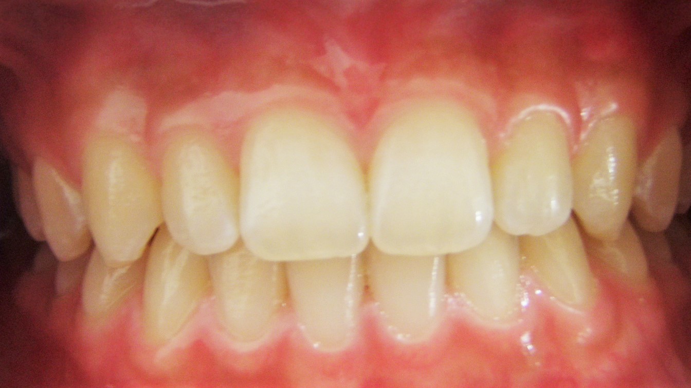 カリエスフリーな１４歳女子 美濃加茂市の歯医者は みやもと歯科 公式 Tel 0574 24 7070