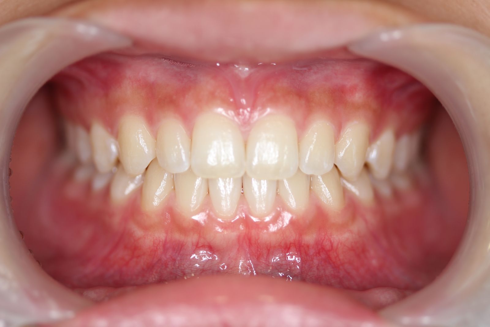 パーフェクト歯列な中3女子 美濃加茂市の歯医者は みやもと歯科 公式 Tel 0574 24 7070